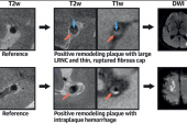 Nonstenotic Intracranial Plaque: An Underrecognized Source of Embolic Stroke